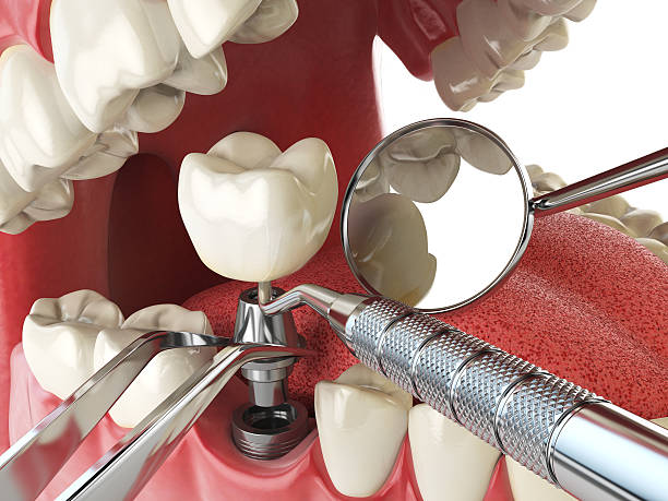 Best Emergency Root Canal Treatment in Katonah, NY